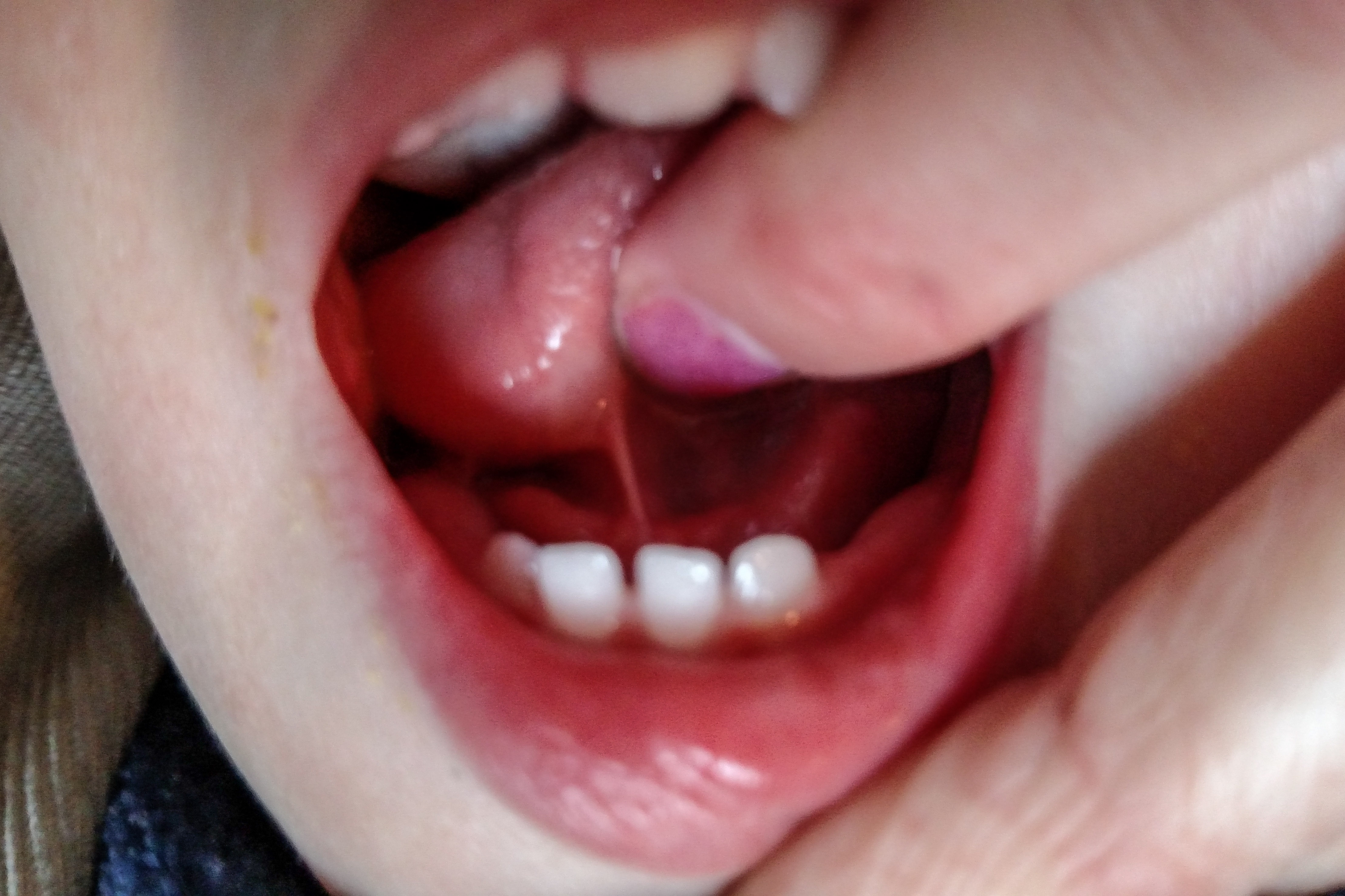 Lip & Tongue Tie in Newborns and Toddlers